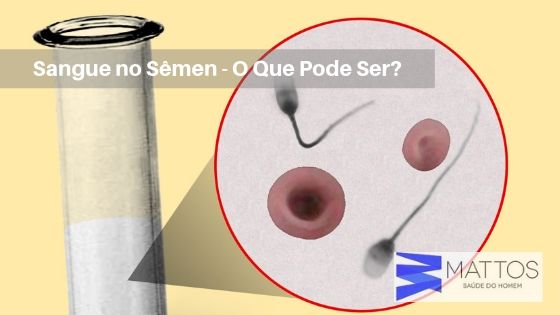 Espermatocele: o que é, sintomas, causas e tratamento - Tua Saúde