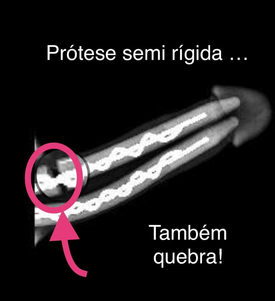 prótese peniana pode quebrar